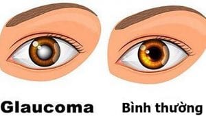 Hình ảnh bình thường và của người bệnh cườm nước